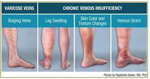 Chronic Venous Insufficiency Advance Foot Clinic Podiatry