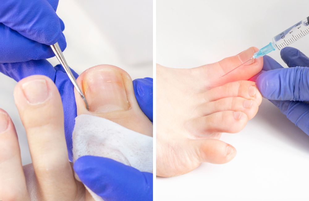 How Do You Treat Ingrown Toenails Advance Foot Clinic Podiatry