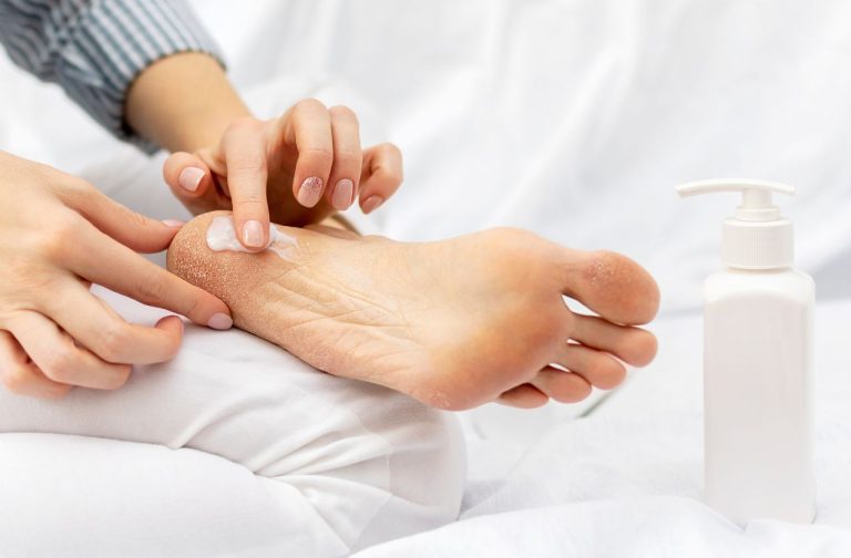 Person rubbing specialised cream into the heel of their foot