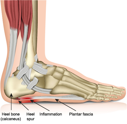 Plantar Fasciitis plantar fasciitis