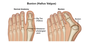 Bunions Advance Foot Clinic Podiatry