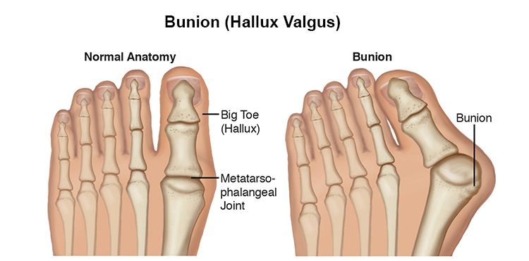Bunions - Advance Foot Clinic Podiatry