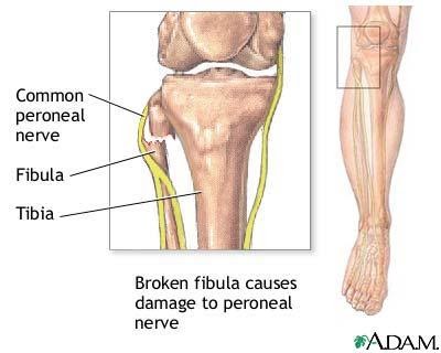 Common Peroneal Nerve Entrapment Advance Foot Clinic Common Peroneal Nerve Entrapment Advance Foot Clinic