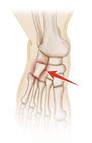 Cuboid Syndrome - Advance Foot Clinic Podiatry