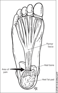 Fat Pad Syndrome - Advance Foot Clinic Podiatry