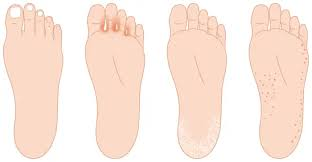 Fungal-infections