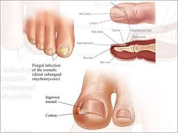 Fungal-nails