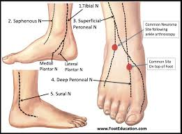 Neuritis