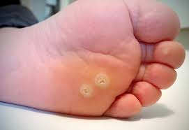 Plantar-Warts