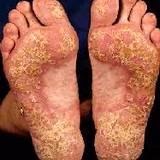 Psoriasis