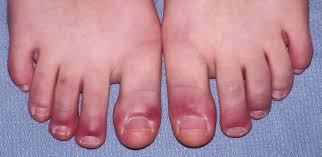 Raynauds-Phenomenon