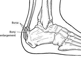 Retrocalcaneal-Bursitis