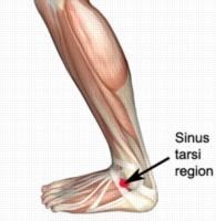 Sinus-Tarsi-Syndrome