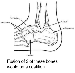 Tarsal-Coalition