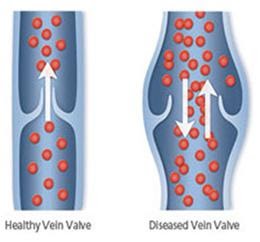 healthy-and-diseased-veins