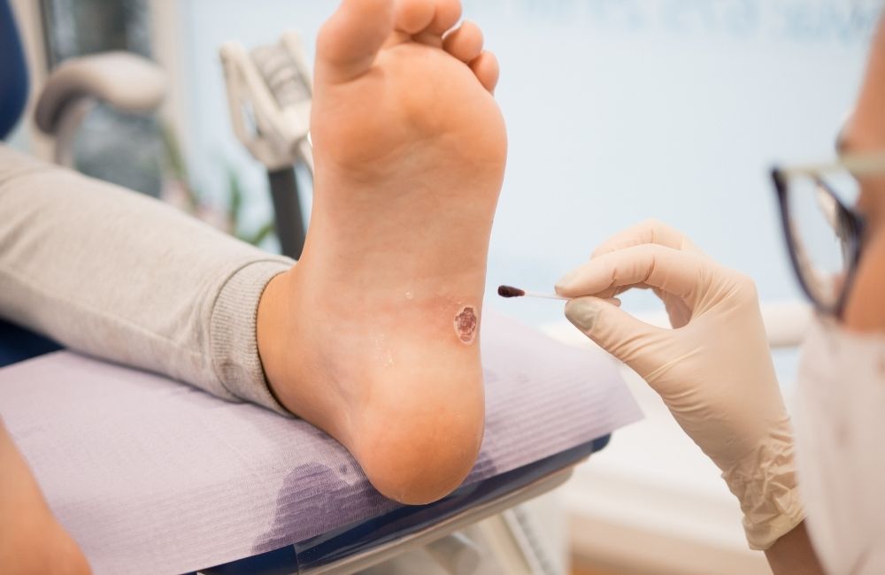 Plantar Wart Treatment Advance Foot Clinic Podiatry