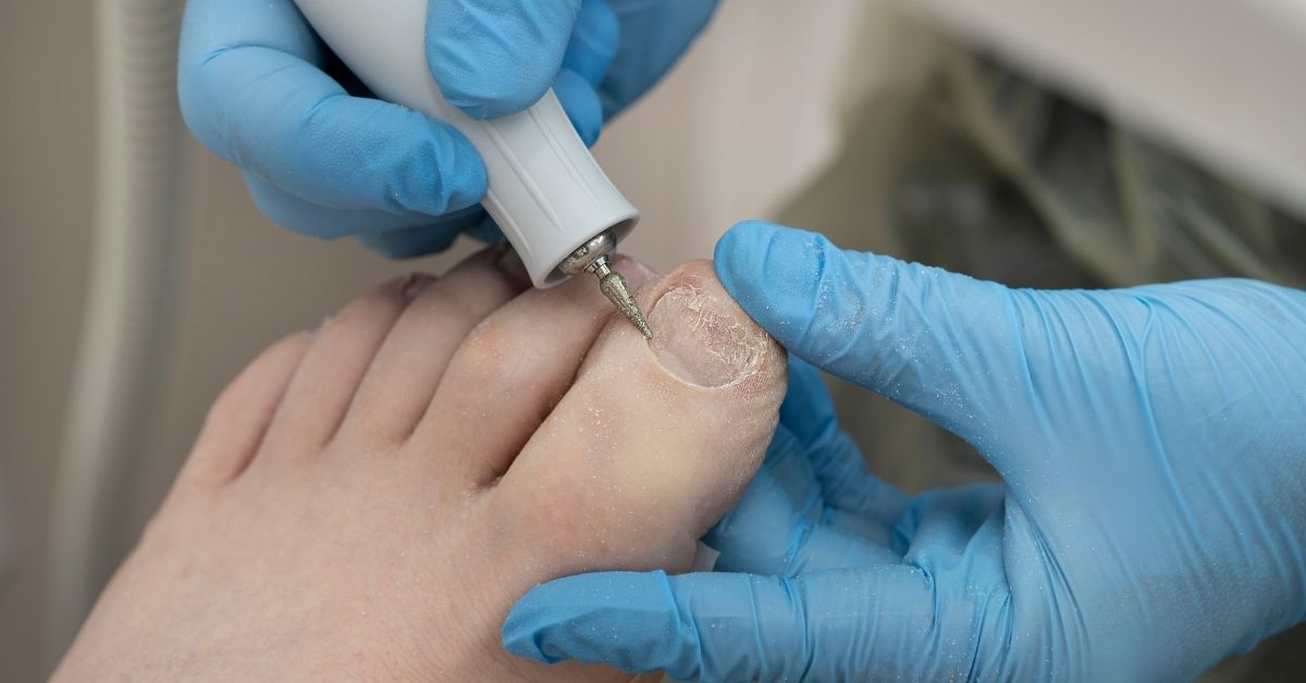 How Do You Treat Fungal Nails? - Advance Foot Clinic Podiatry