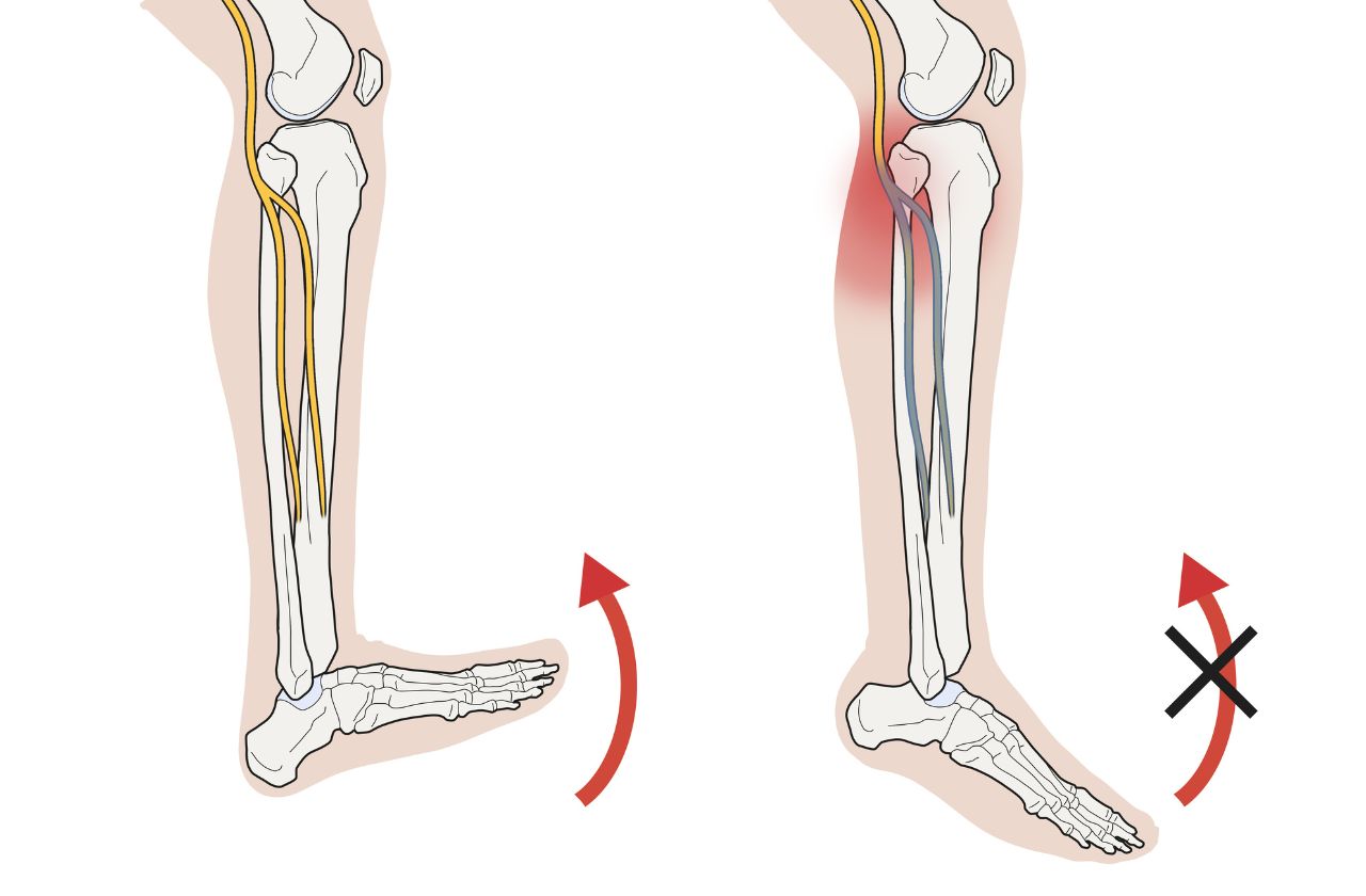 Richie Brace Advance Foot Clinic Podiatry