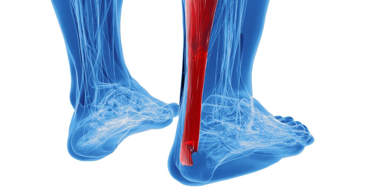 Achilles Tendonitis Advance Foot Clinic Podiatry