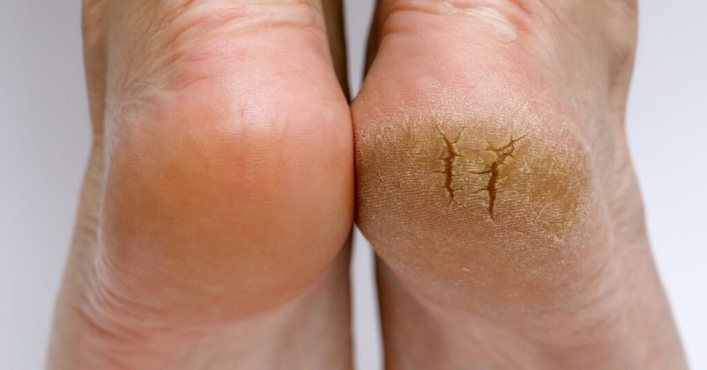 Our podiatrist blog explains what is callus and how this hard skin can be prevented