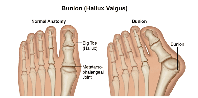 Bunion T