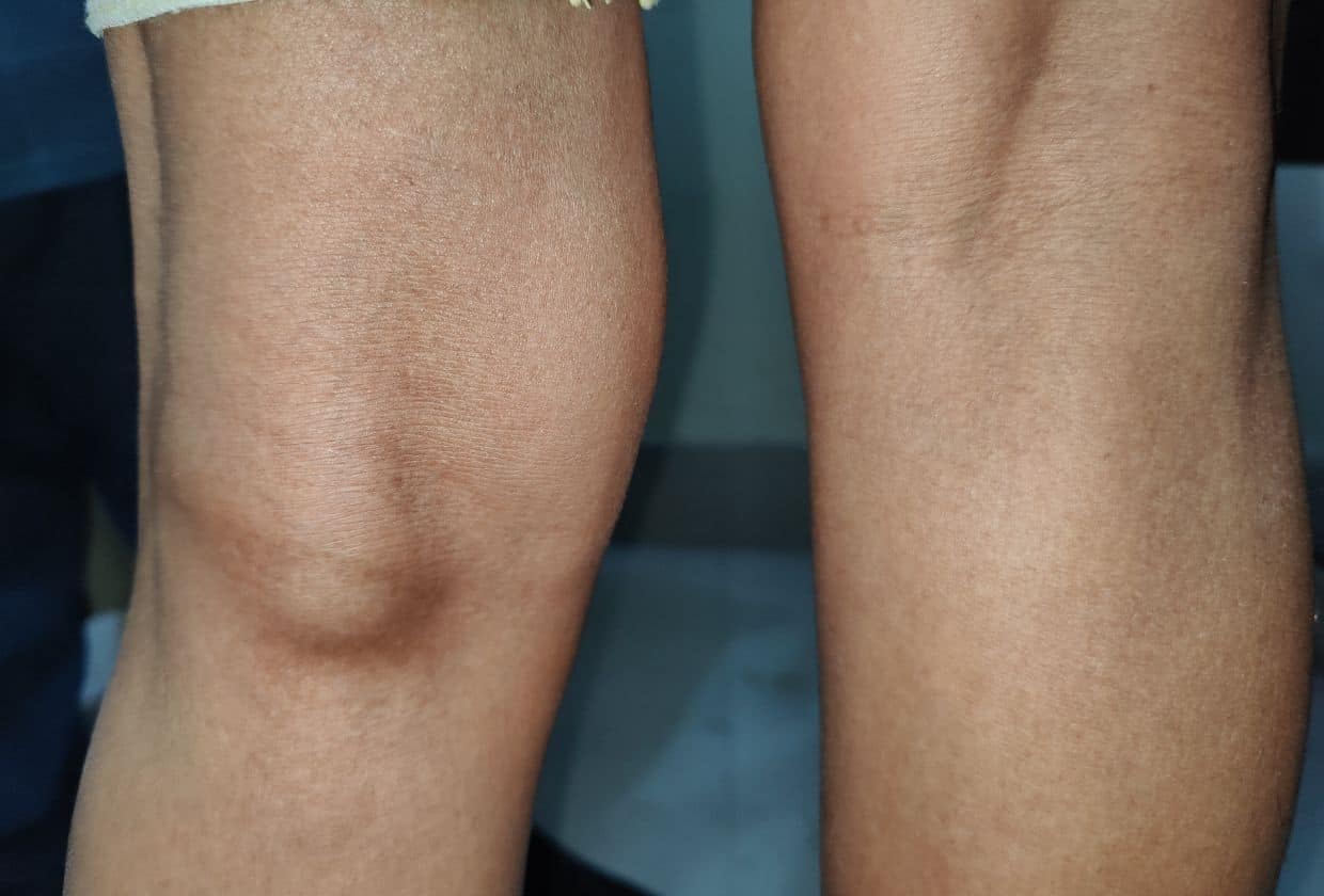 An image of the photos of someone's legs who has Baker's Cyst