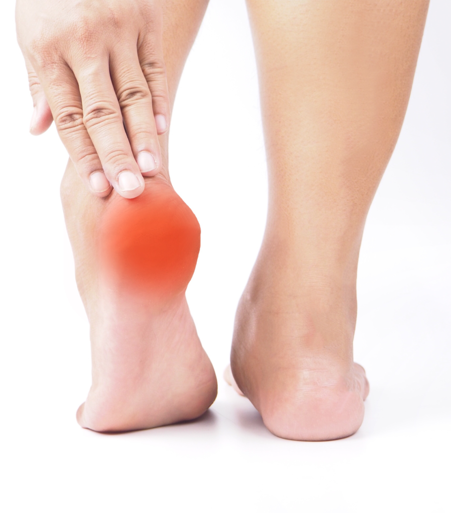 Plantar fasciitis is a common cause of heel pain and burning feet