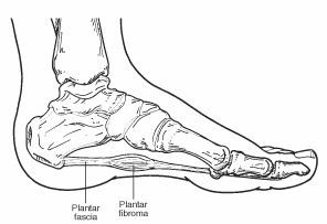 Foot orthotic for plantar on sale fibroma