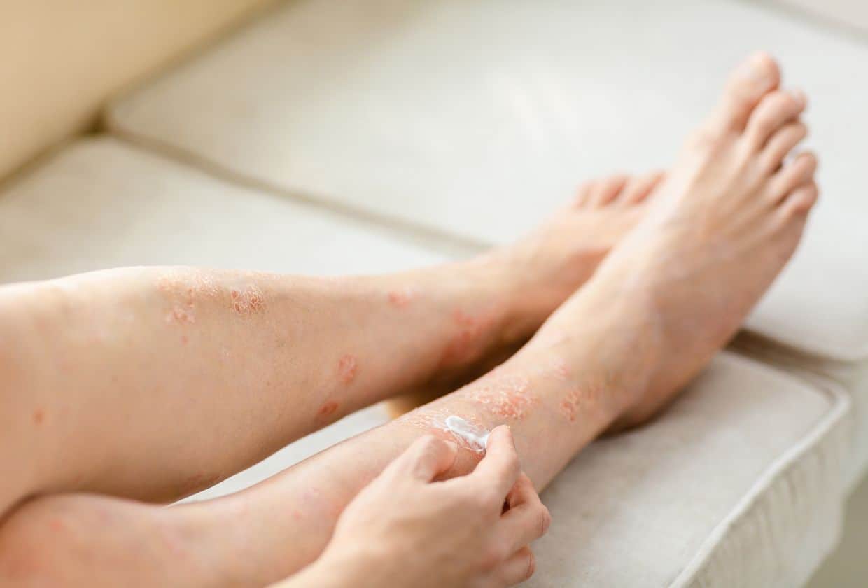 An image of painful psoriasis on legs