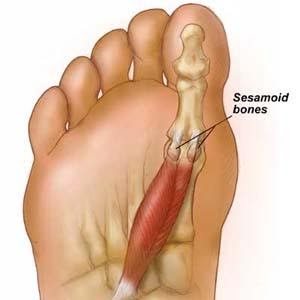 Sesamoiditis