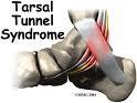 Tarsal