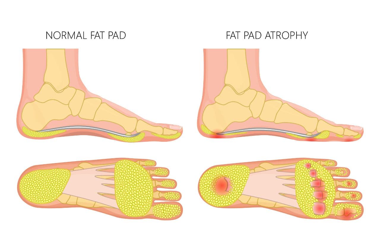 Sore foot at pad syndrome