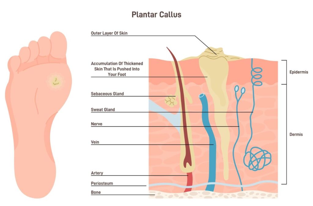 Illustration of a callus which answers the question what is a callus