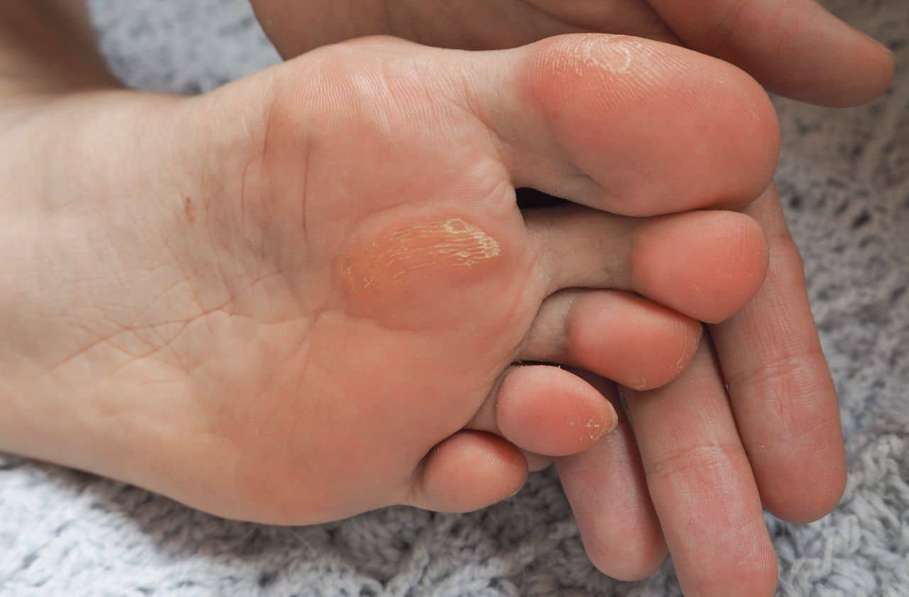 Photograph of a callus on the foot Corns and Callus