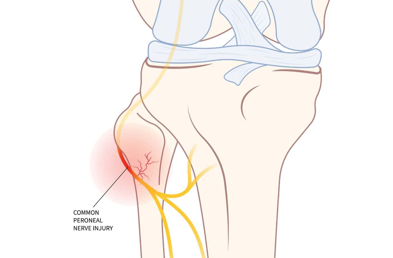 A drawing of where common peroneal pain can be felt in the knee Common Peroneal Nerve Entrapment