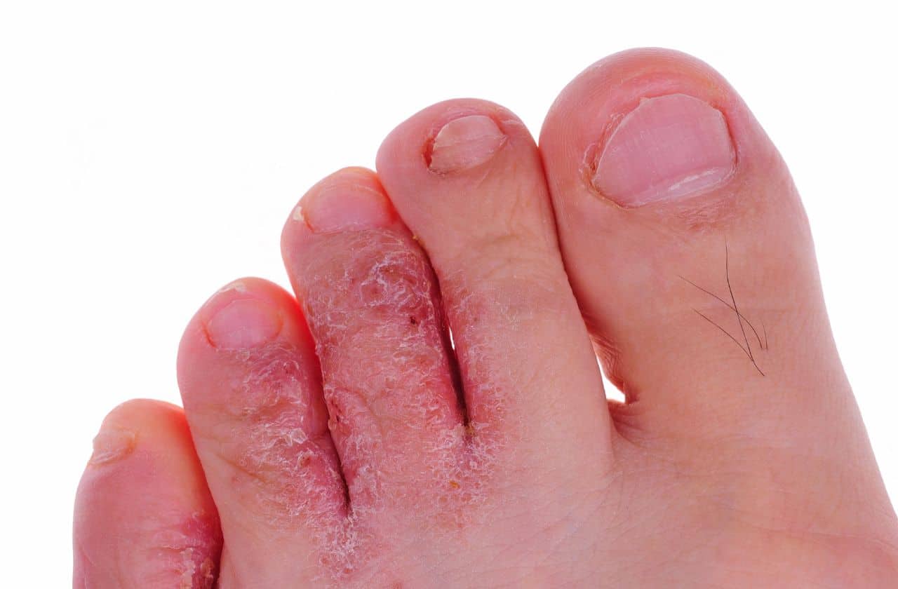 Image of fungal infected toes