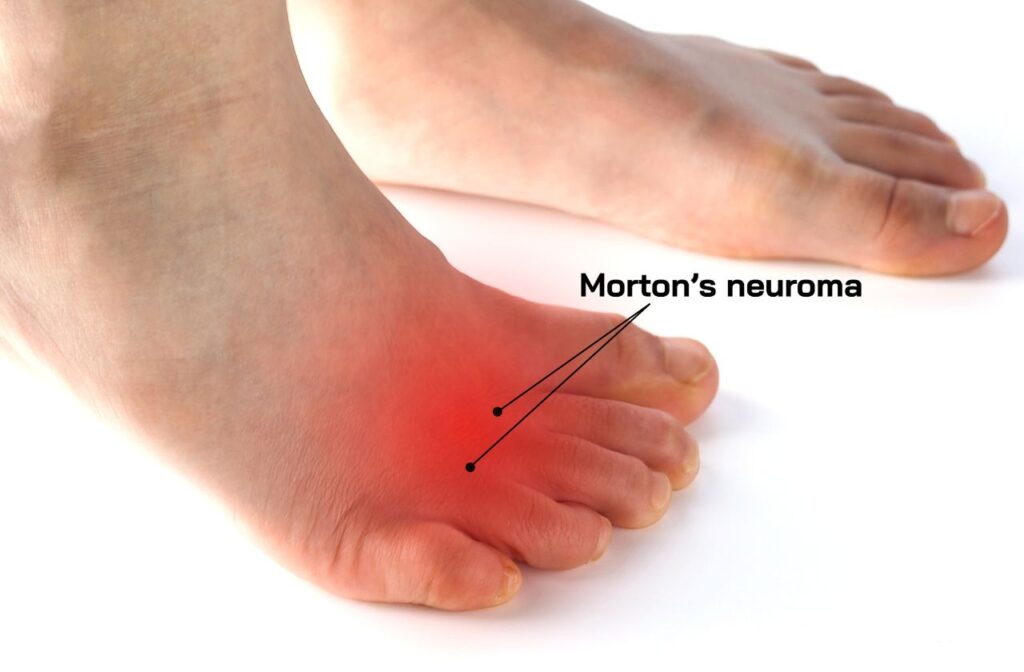 Image of inflamed foot due to a Morton’s Neuroma which causes burning in feet