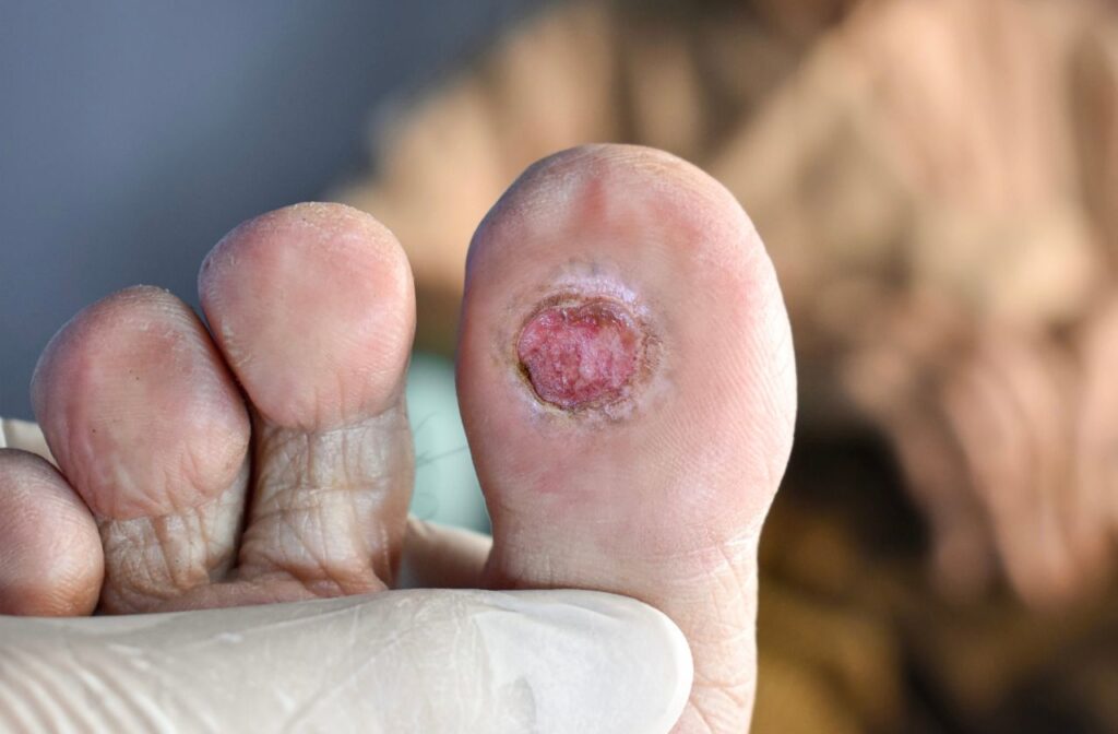 foot ulcer laser therapy treatment