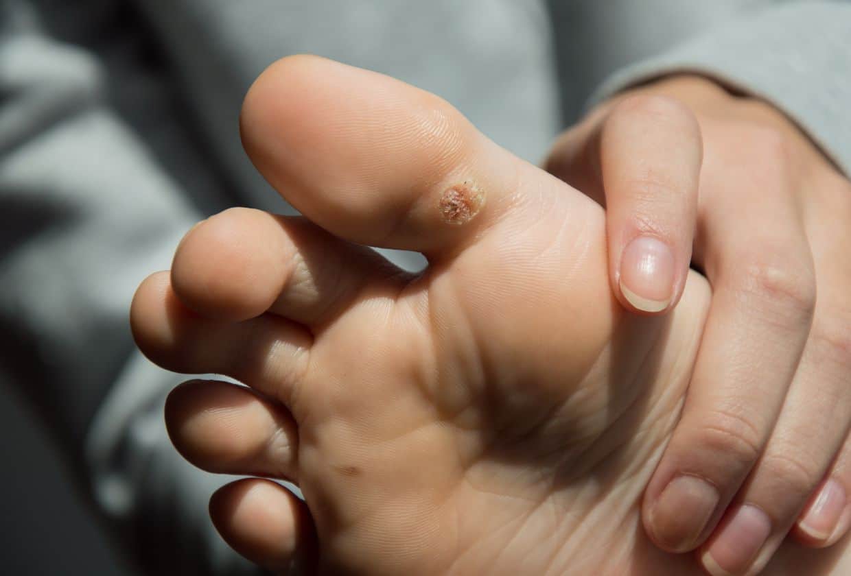 Image of someone holding their foot, showing some warts