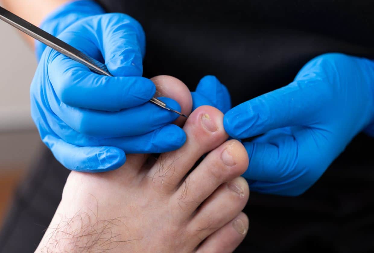 Close up of podiatrist holding ingrown toenail, about to treat it