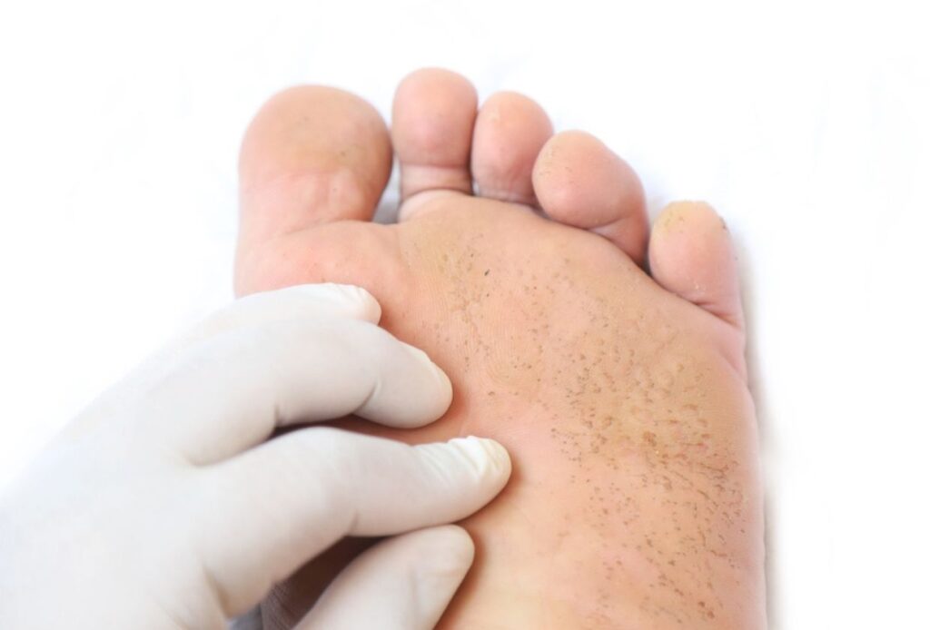 Pitted Keratolysis - Advance Foot Clinic Podiatry