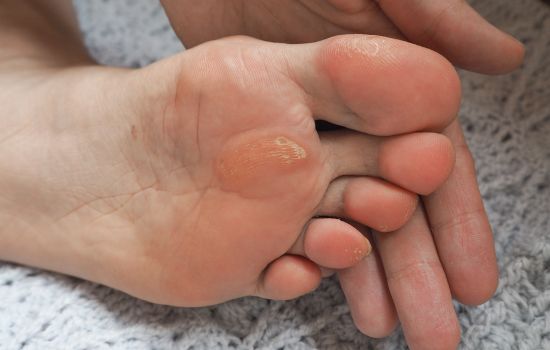 5-common-causes-of-foot-pain-Corns and Calluses