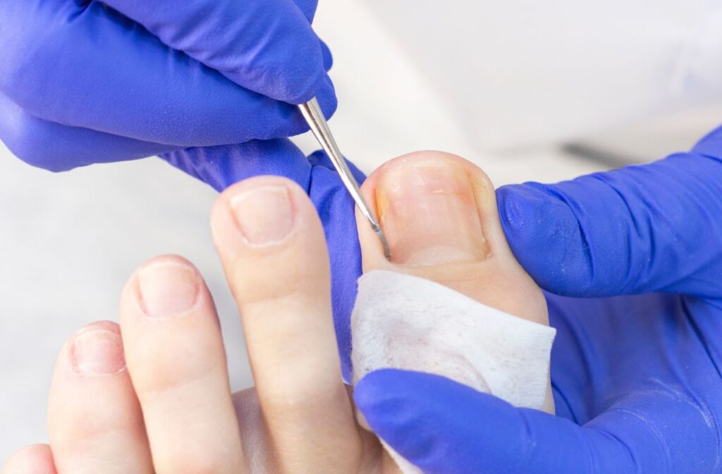 ingrown nails are a common foot health concern in children