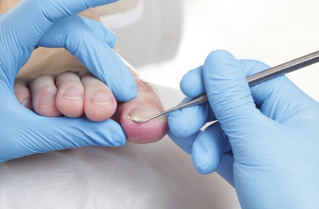 ingrown toenails are a common foot health issue in men