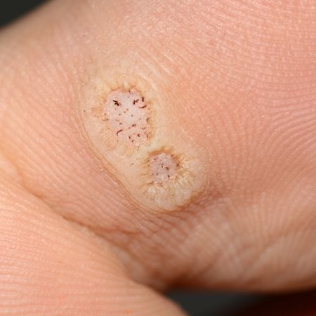 plantar warts treated by podiatrist