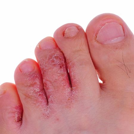 athlete's foot is one of the skin conditions podiatrists treat