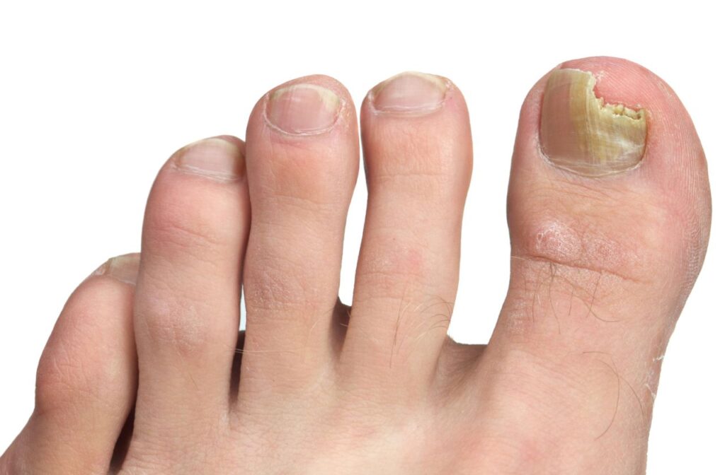 are you at risk of getting a fungal nail infection