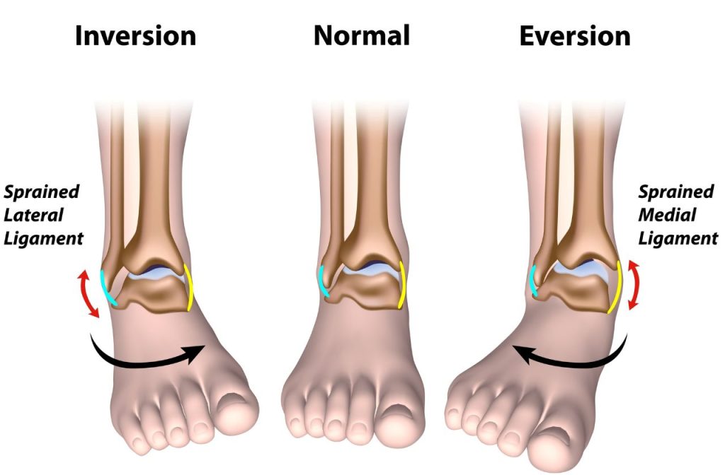 Ankle sprain types illustrated