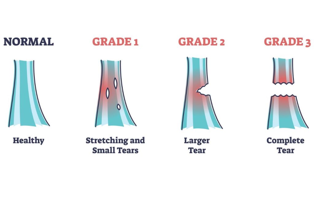 three grades of sprains graphic illustration