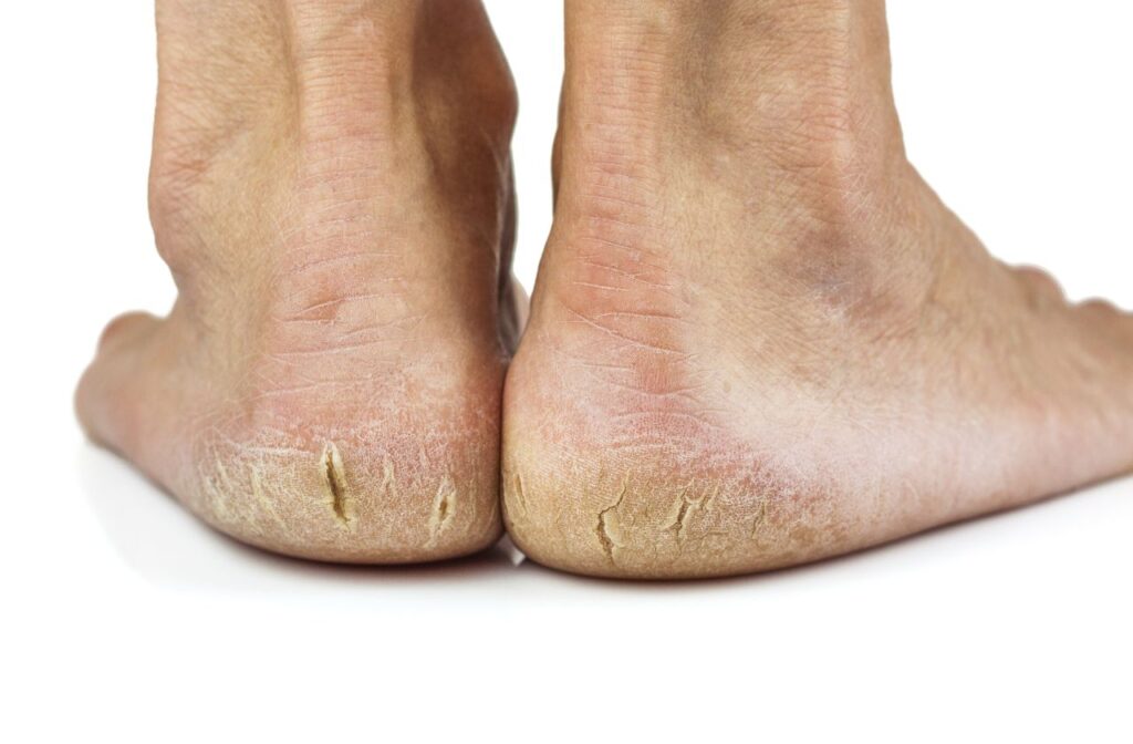 cracked feet and cracked heels have a number of causes but the main one is build up of callus on the feet